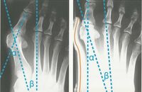 Hallux Valgus