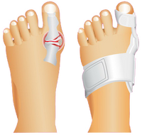 Hallux Valgus Schiene